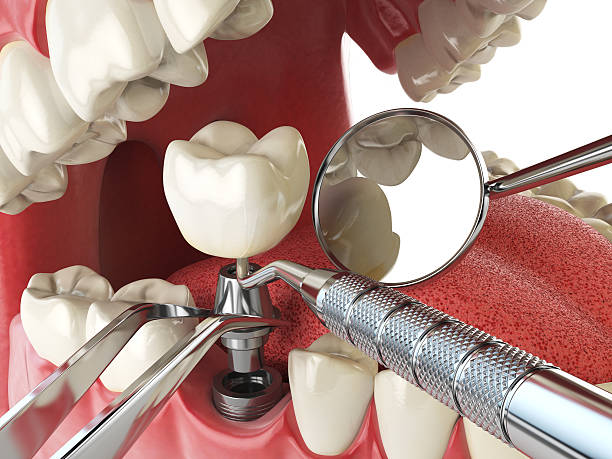 Best Emergency Root Canal Treatment in Odessa, MO
